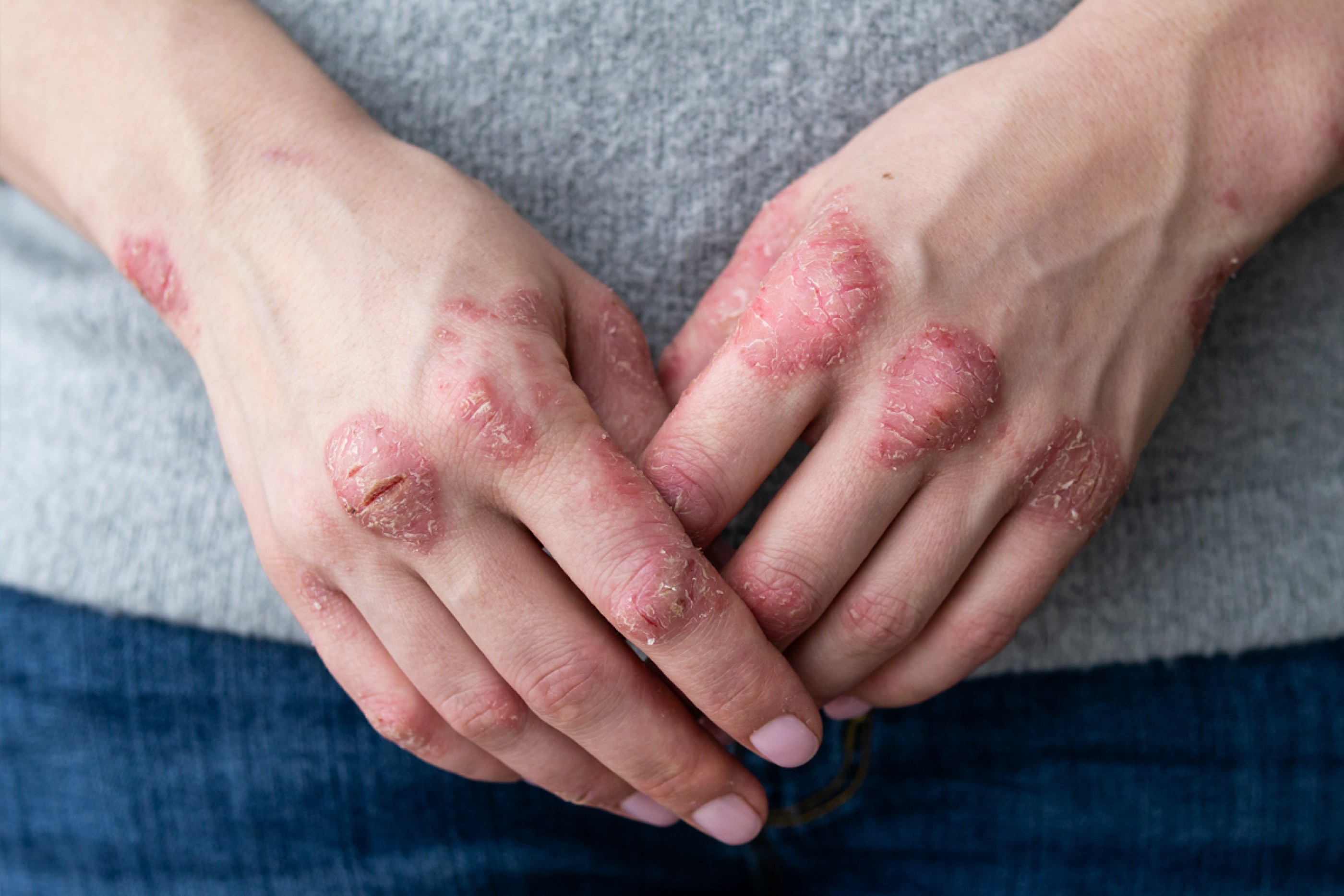 Close-up of scaly plaques on the hands—symptoms seen in psoriasis or eczema.