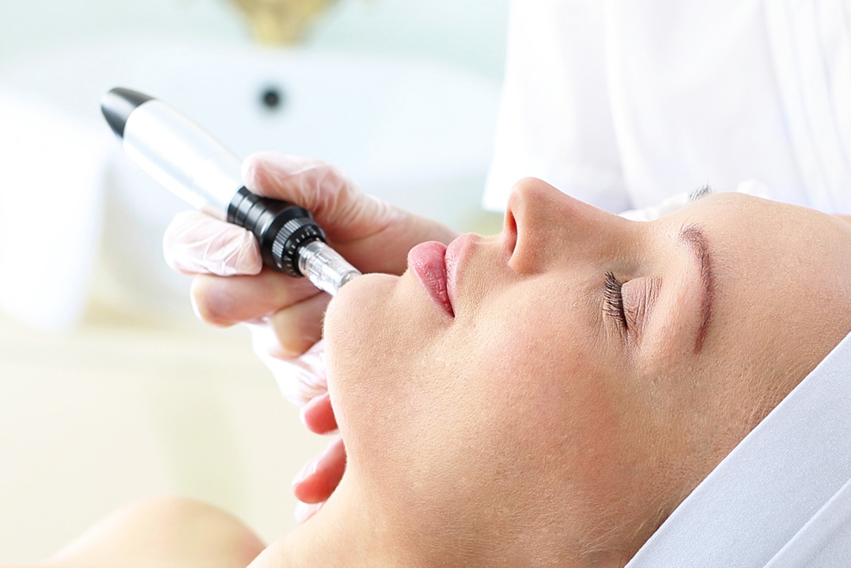 Microneedling