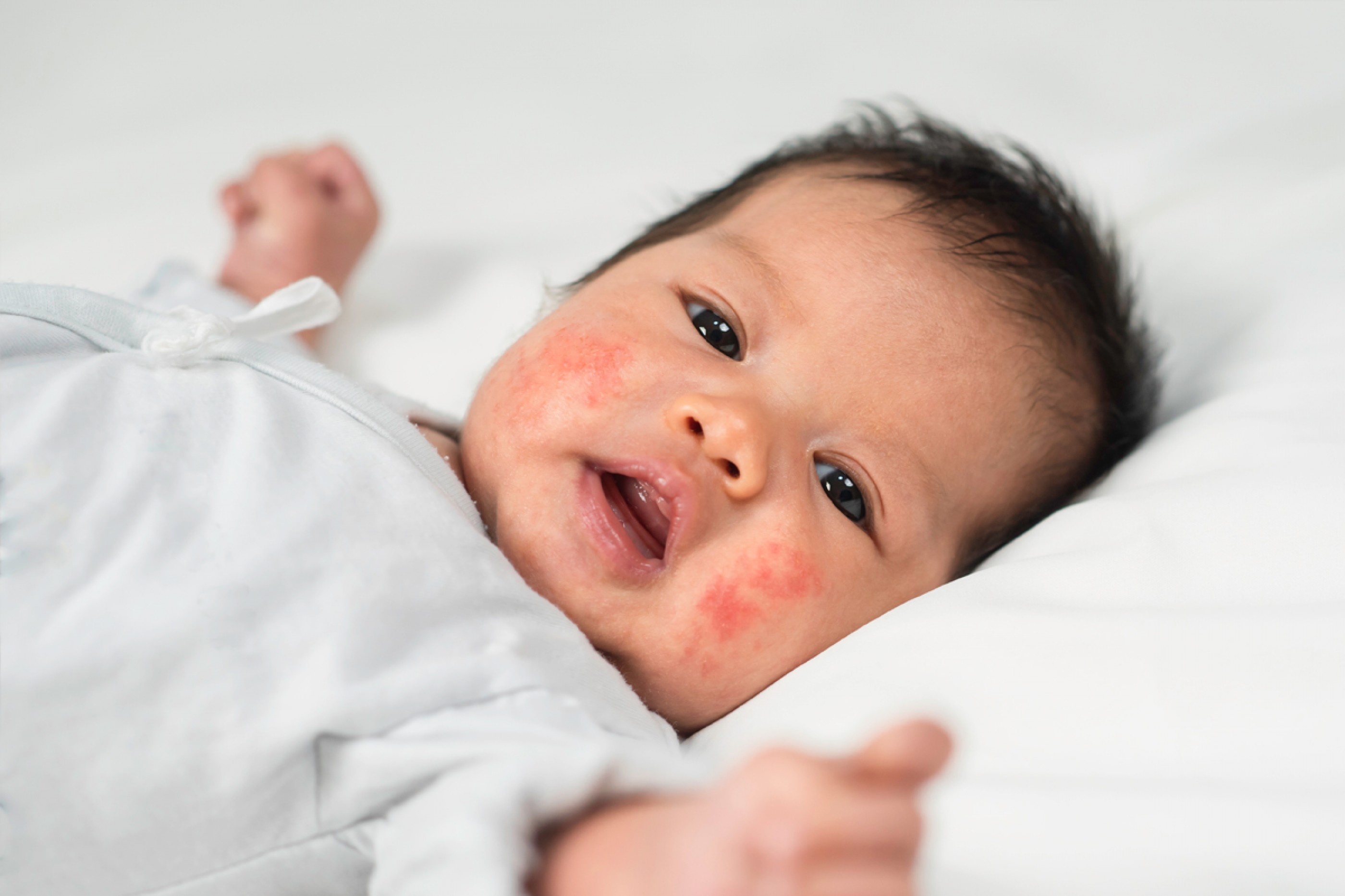 Infant with red facial rash—pediatric dermatology care for baby and child skin conditions.