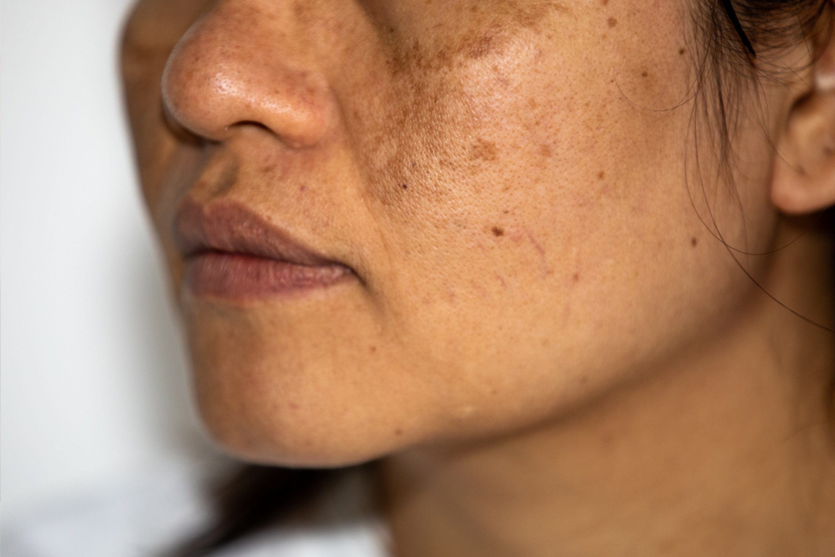 Facial hyperpigmentation with dark spots and melasma on the cheek.
