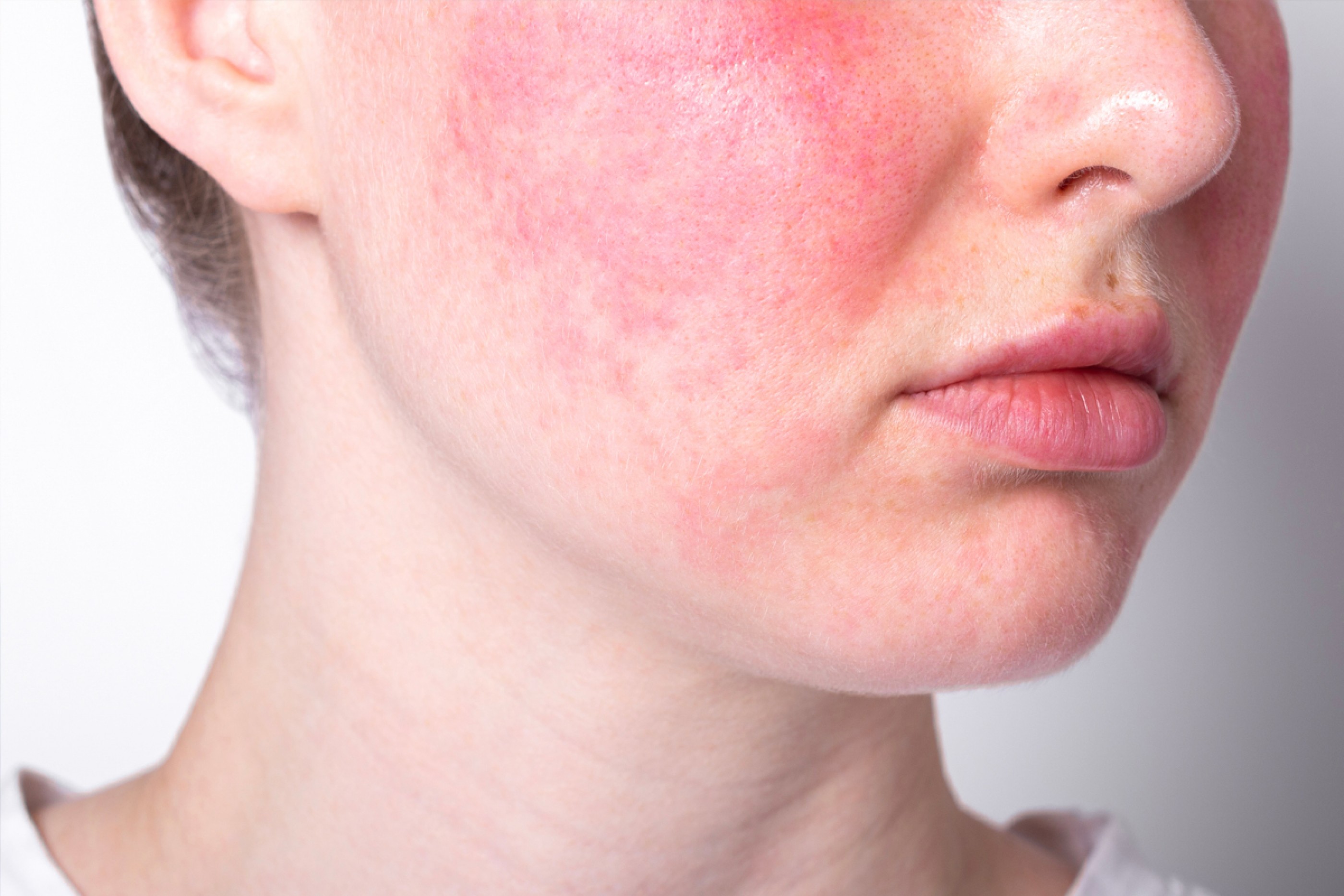 Close-up of facial redness and visible irritation from rosacea on the cheek.