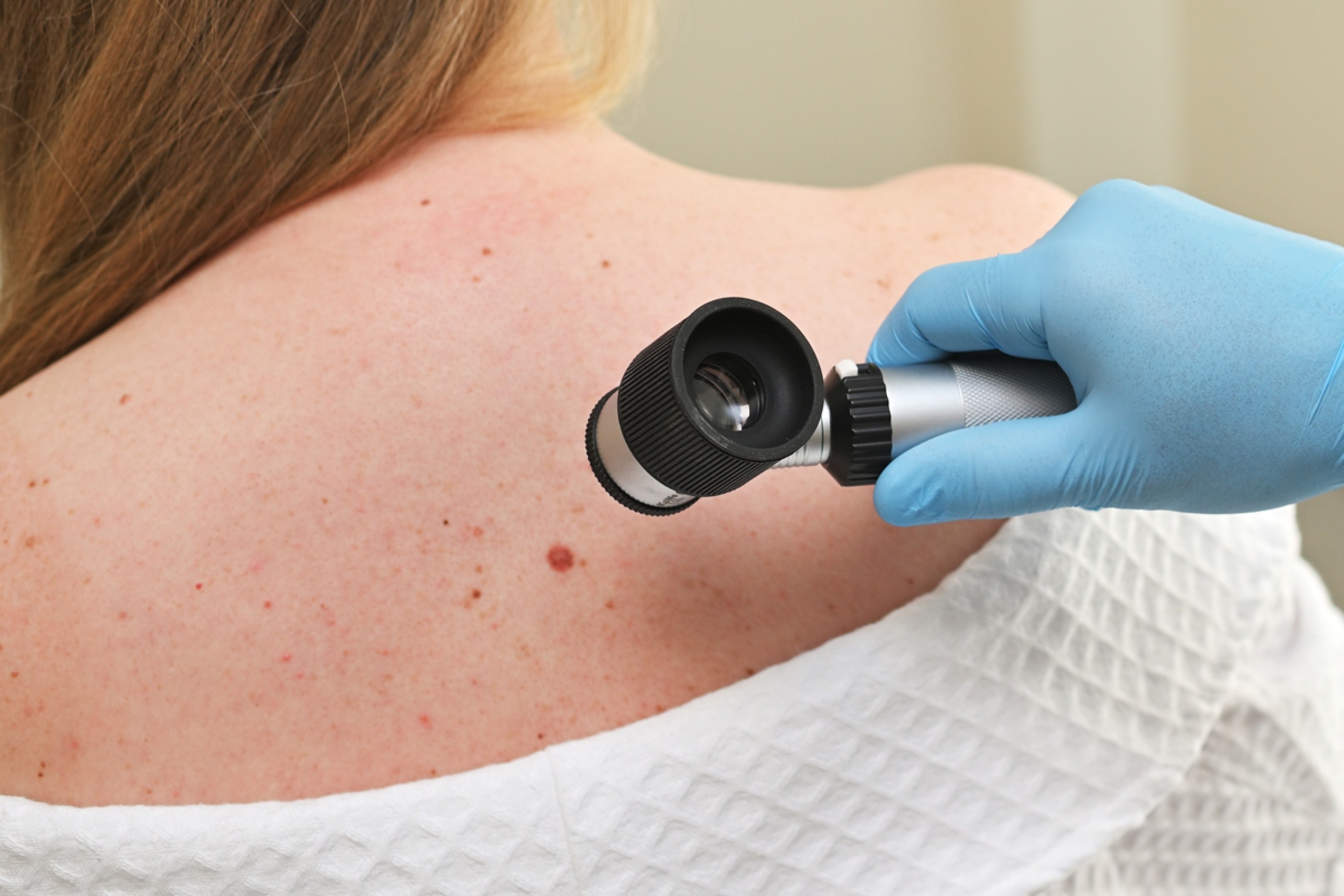 Dermatologist examining a changing mole with a dermatoscope during a skin cancer check.