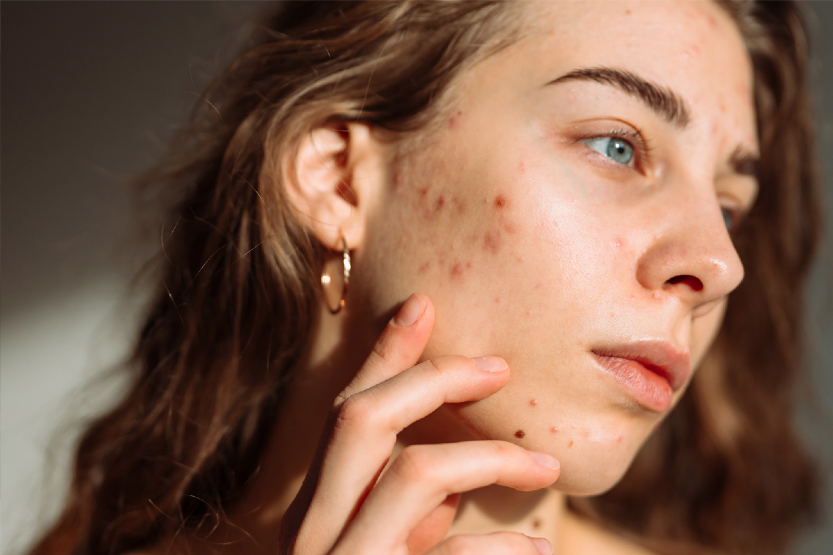 Close-up of young woman with acne and acne scars on her cheek.