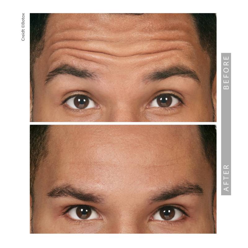 Closeup on a before and after comparative images on a man. Both pictures frames the eyes and forehead. The eyebrows are lifted in both images. In the before image several strong wrinkle lines appearing on his forehead. In the after image those lines and wrinkles disappeared.