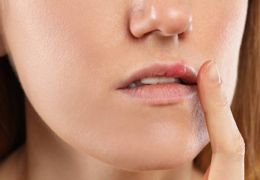 Cold Sore or Pimple? How to Tell the Difference