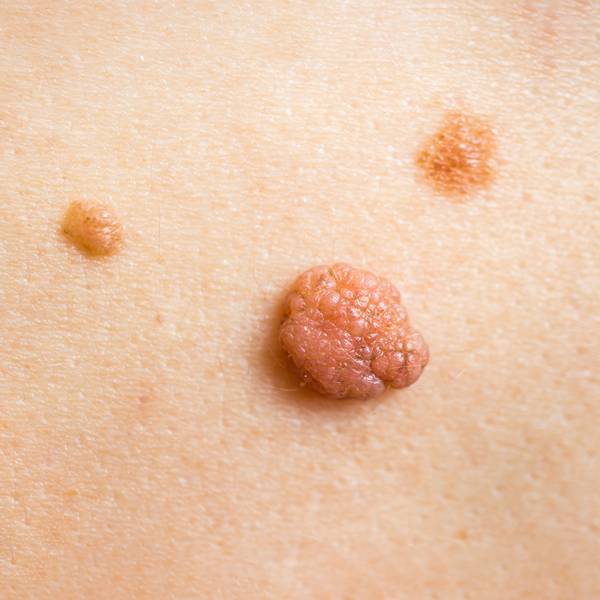 Skin Tags: Understanding Causes, and Treatments