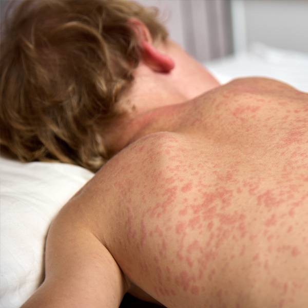 Measles and Skin: Recognizing Symptoms, Healing Stages, and When to Seek Care