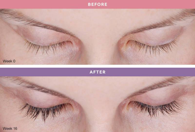 Closeup on a woman’s eyebrows and eyes. She has very few thin eyelashes. After Latisse treatment she has fuller and thicker lashes.