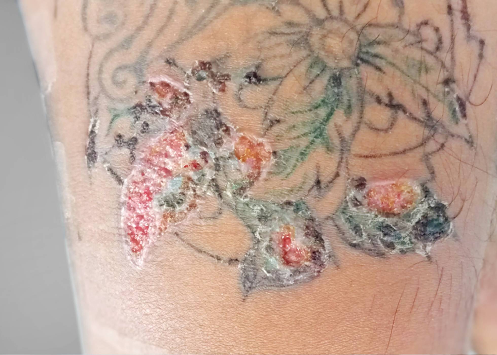 Tattoo Still Leaking Plasma? What to Do