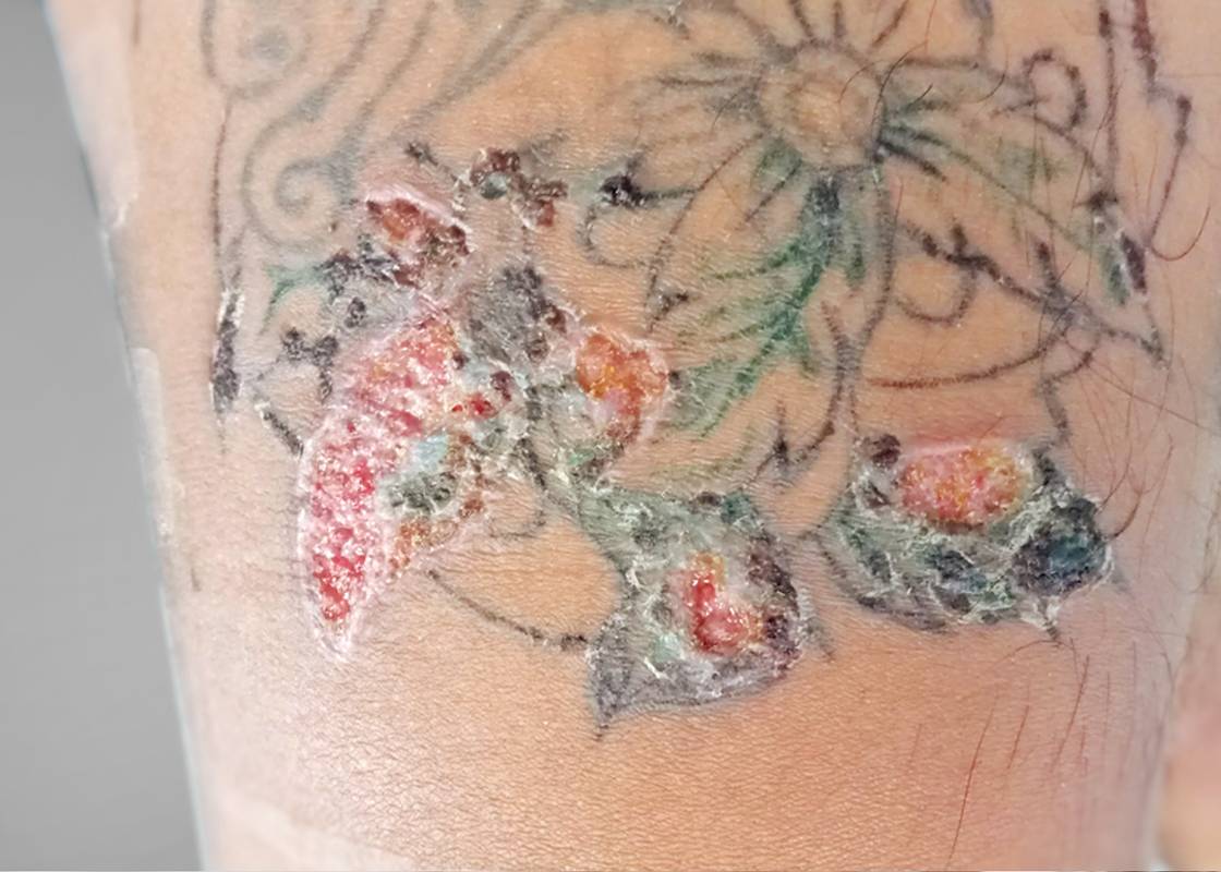 Tattoo InkRelated Infections  Awareness Diagnosis Reporting and  Prevention  NEJM