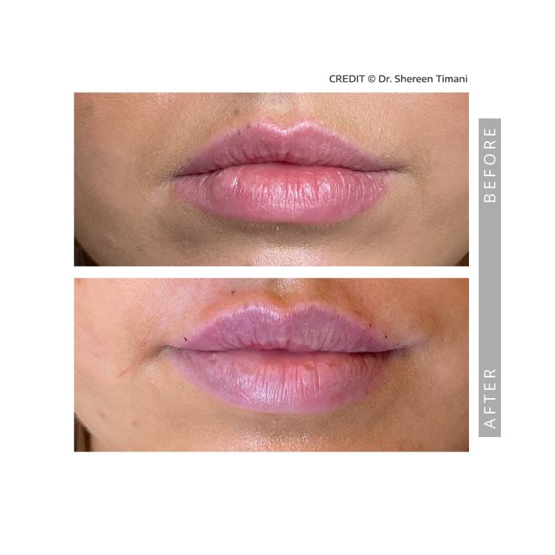 Closeup on a before and after comparative images on a woman. Both pictures frames the woman's lips.  In the before image we can see the woman's original lip size. In the after image we her lips plumped with a more defined shape.