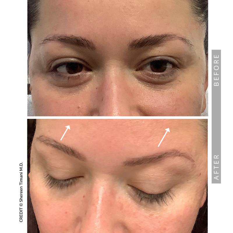 Closeup on a before and after comparative images on a woman. Both pictures frame the woman's eyes.  In the before image we can see the eye lids dropping on the eye.. In the after image we her eyelid lifted with natural-looking results.