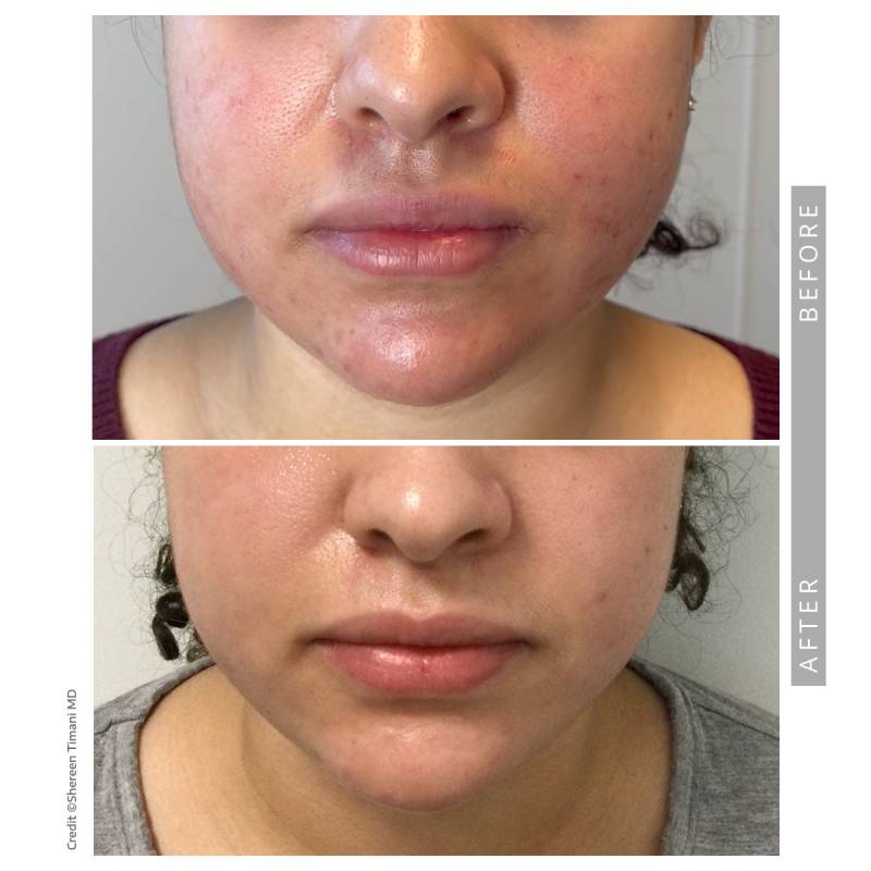 Closeup on a before and after comparative images on a woman. Both pictures frames the lower part of a young woman’s face. In the before image we can see she has acne and redness of skin . In the after image her skin is clear.