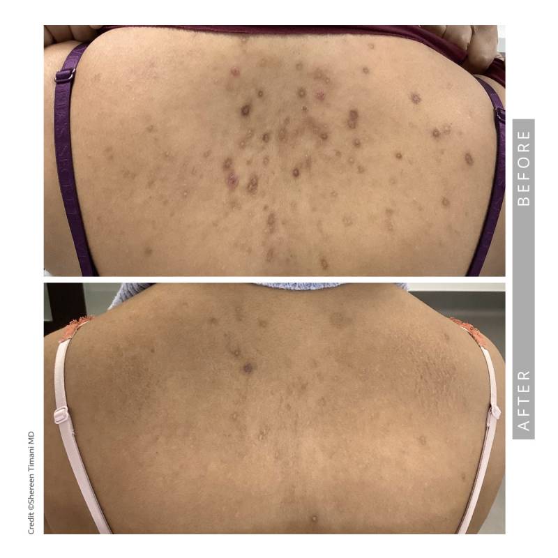 Closeup on a before and after comparative images. Both pictures frames the upper back of a woman. In the before image we can see acne scars and dark skin patches due to the acne. In the after image the dark circles have cleared up.