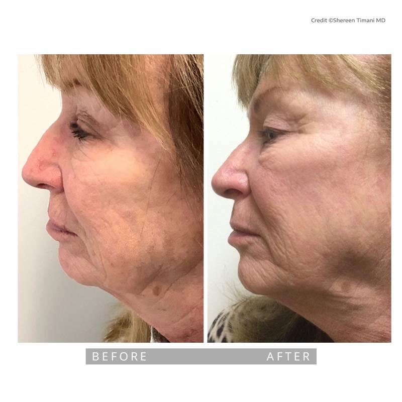 Closeup on a before and after comparative images. Both pictures frames the profile of a mature woman. In the before image we can see precancerous lesions on her nose, some pigmentation and lines due to aging . In the after image we can see a significant improvements.
