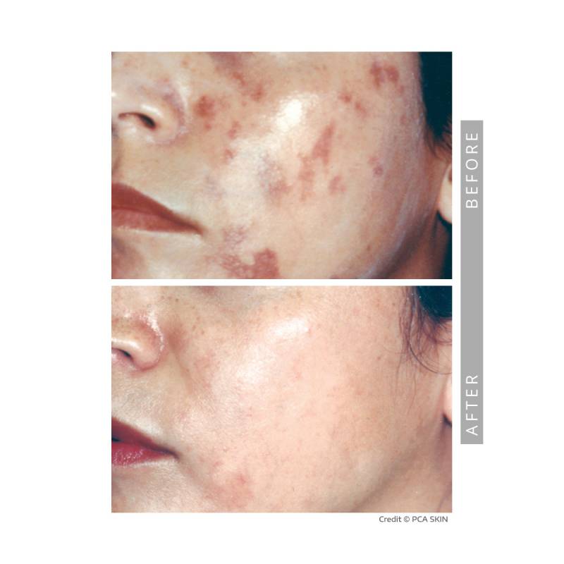 Closeup on a before and after comparative images on a woman's cheeks. Both pictures frames the lower part of a young woman’s face. In the before image we can see she has Hyper-pigmentation. In the after image her skin is clear.