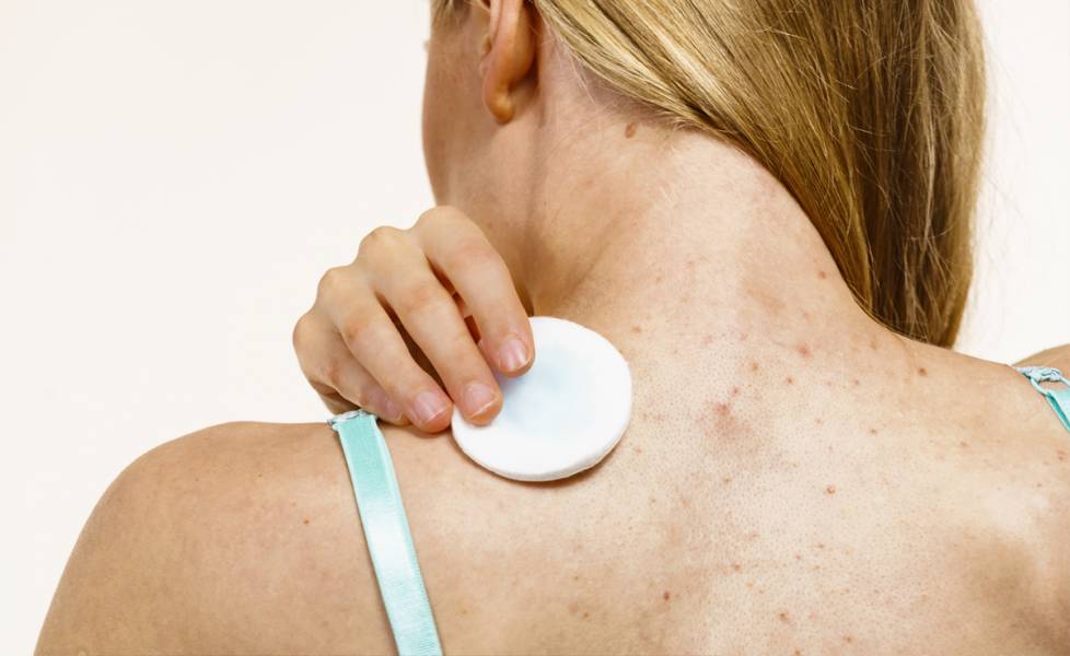 Can Chemical Peels Help Back Acne?
