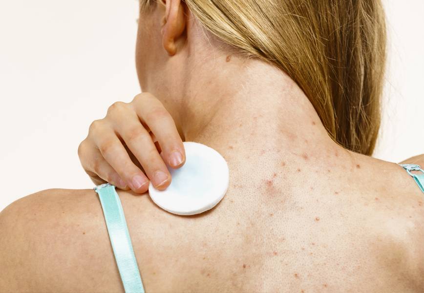 Can Chemical Peels Help Back Acne?