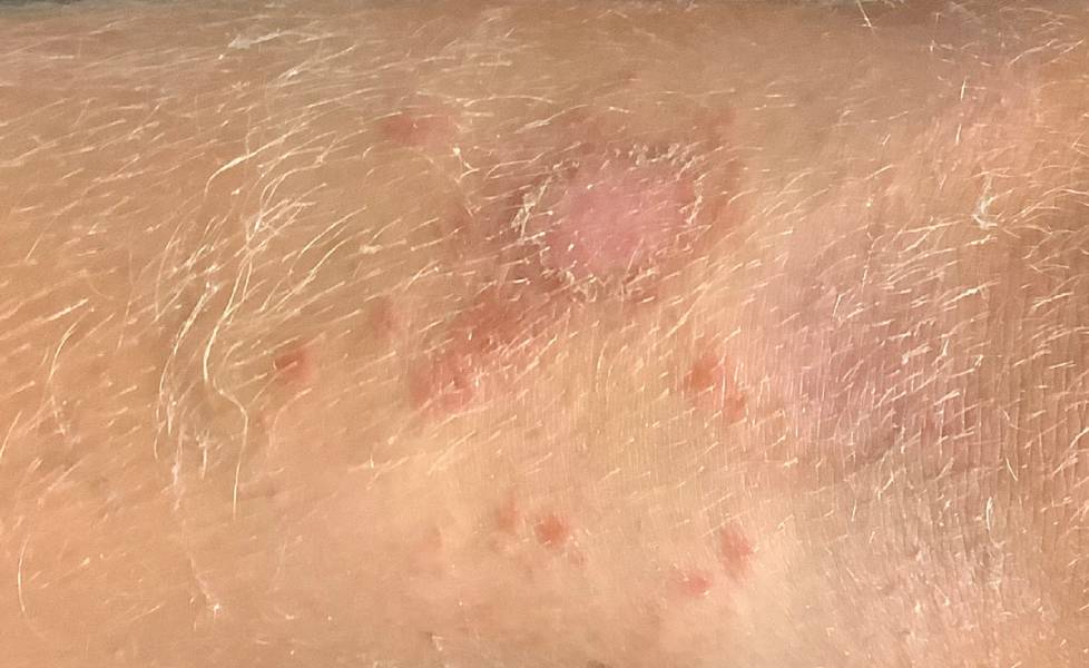 Impetigo: Understanding the Causes, Symptoms, and Treatment of This Common Skin Infection