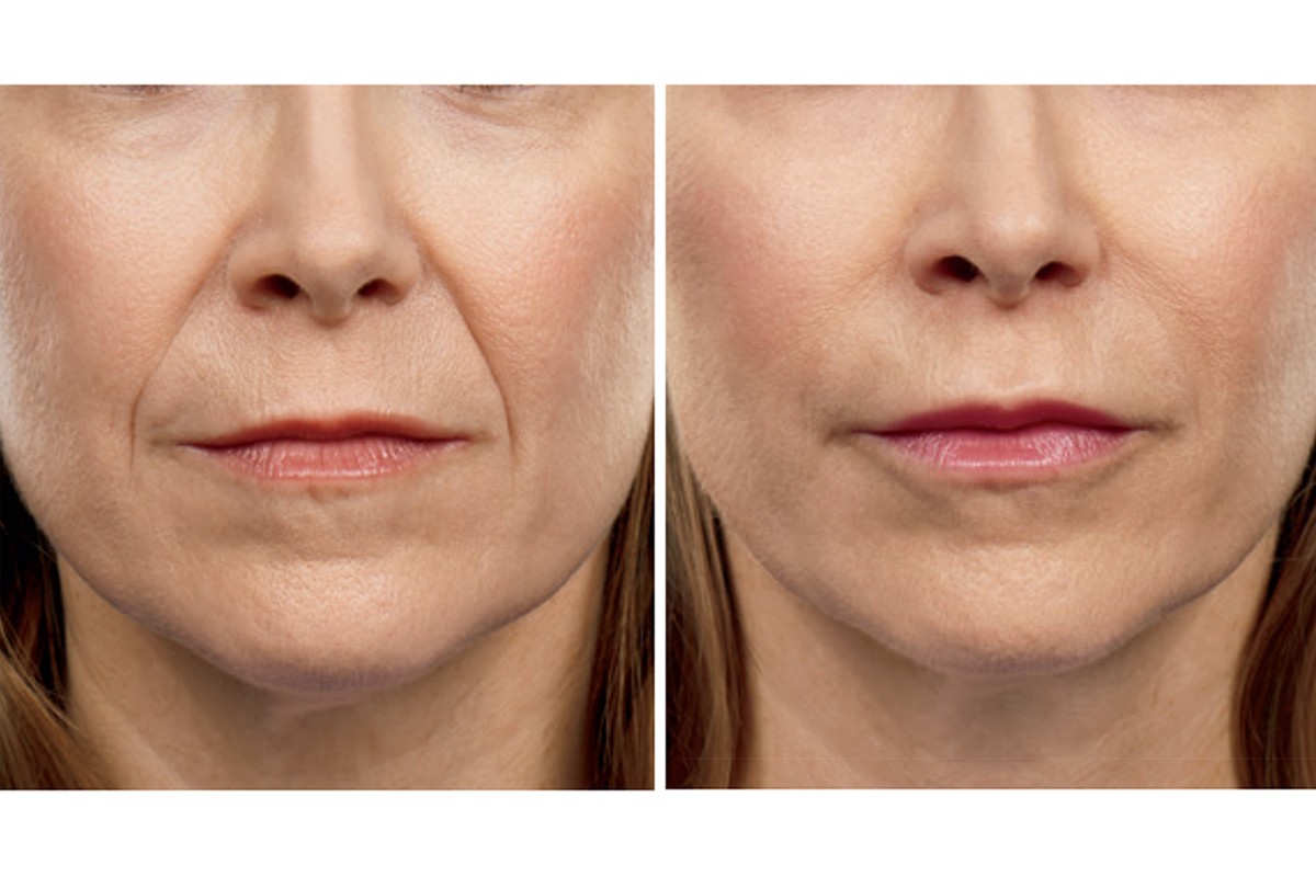 $240 Skincare Gift with 2 Juvéderm® Syringes | Sandy Springs