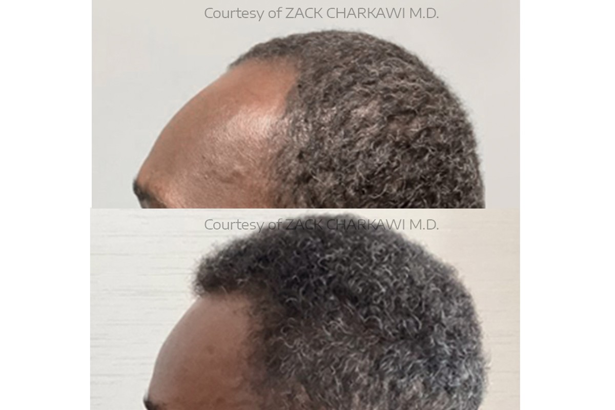 Free FUE Hair Transplant Consultation | Johns Creek GA